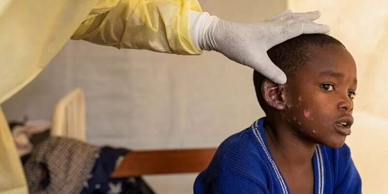 Kasus Mpox Impor dari Afrika